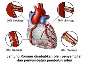 ciri ciri penyakit jantung koroner